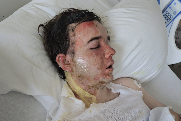 Hospital patient rests with eyes closed as visible burns and redness cover much of his face and neck.