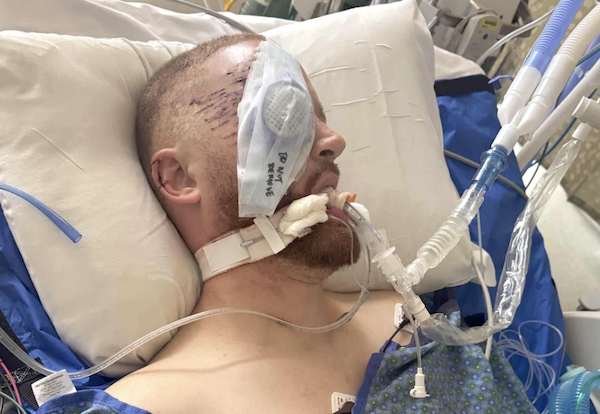 An injured man rests in a hospital bed while receiving ventilator support and other intensive-care treatment.